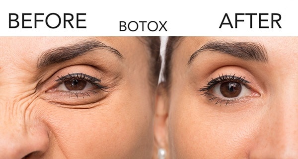 BOTOX FAIRFAX, VA Botox Fairfax – Botox Deals in Fairfax, VA