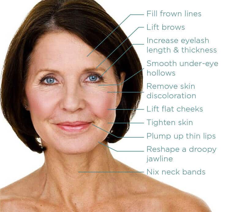 GET YOUR GLOW BACK menopause woman restylane treatment areas 1
