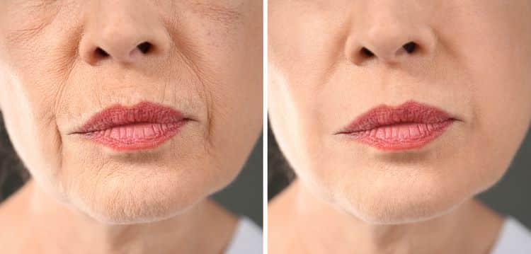 Lip Line Smoothing Injections 1 1