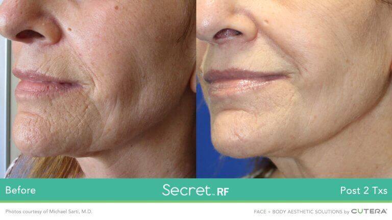 Microneedling for facial around the mouth wrinkles removal 1