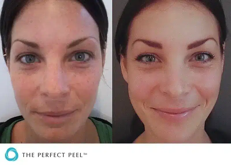 before and after the perfect peel
