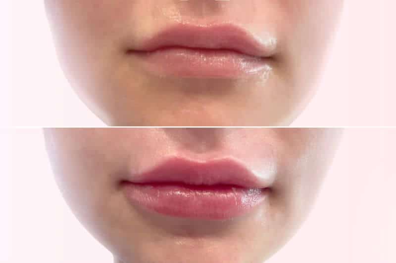 $499 for Lip Injections - correct botched lip filler.