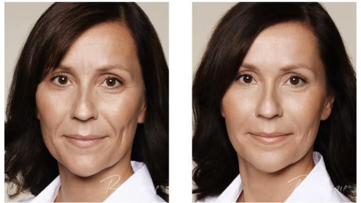 restylane-refyne-before-and-after-patient-2 (1)