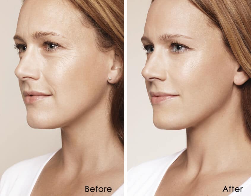 restylane refyne smooth facial wrinkles 1