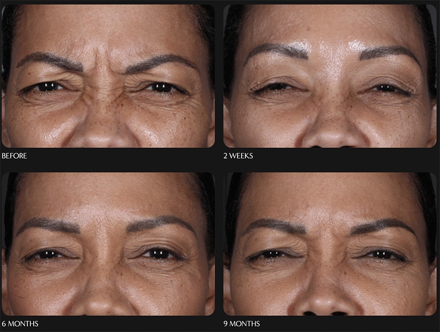DAXXIFY NEAR ME (BETTER BOTOX ) LESS EXPENSIVE - LASTS LONGER (Up to 6mts)