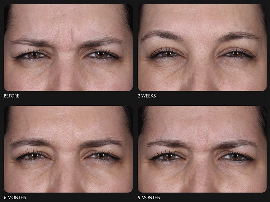 DAXXIFY (BETTER BOTOX ) LESS EXPENSIVE - LASTS LONGER (Up to 6mts)