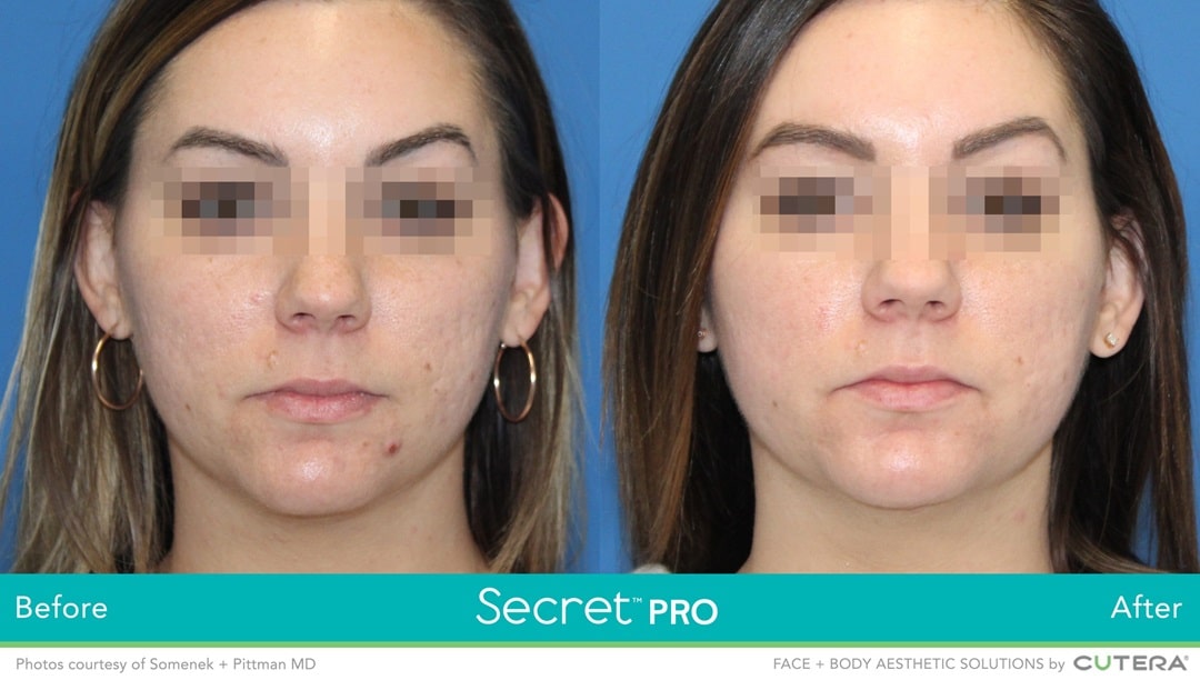 Secret Pro Before and After co2 laser resurfacing