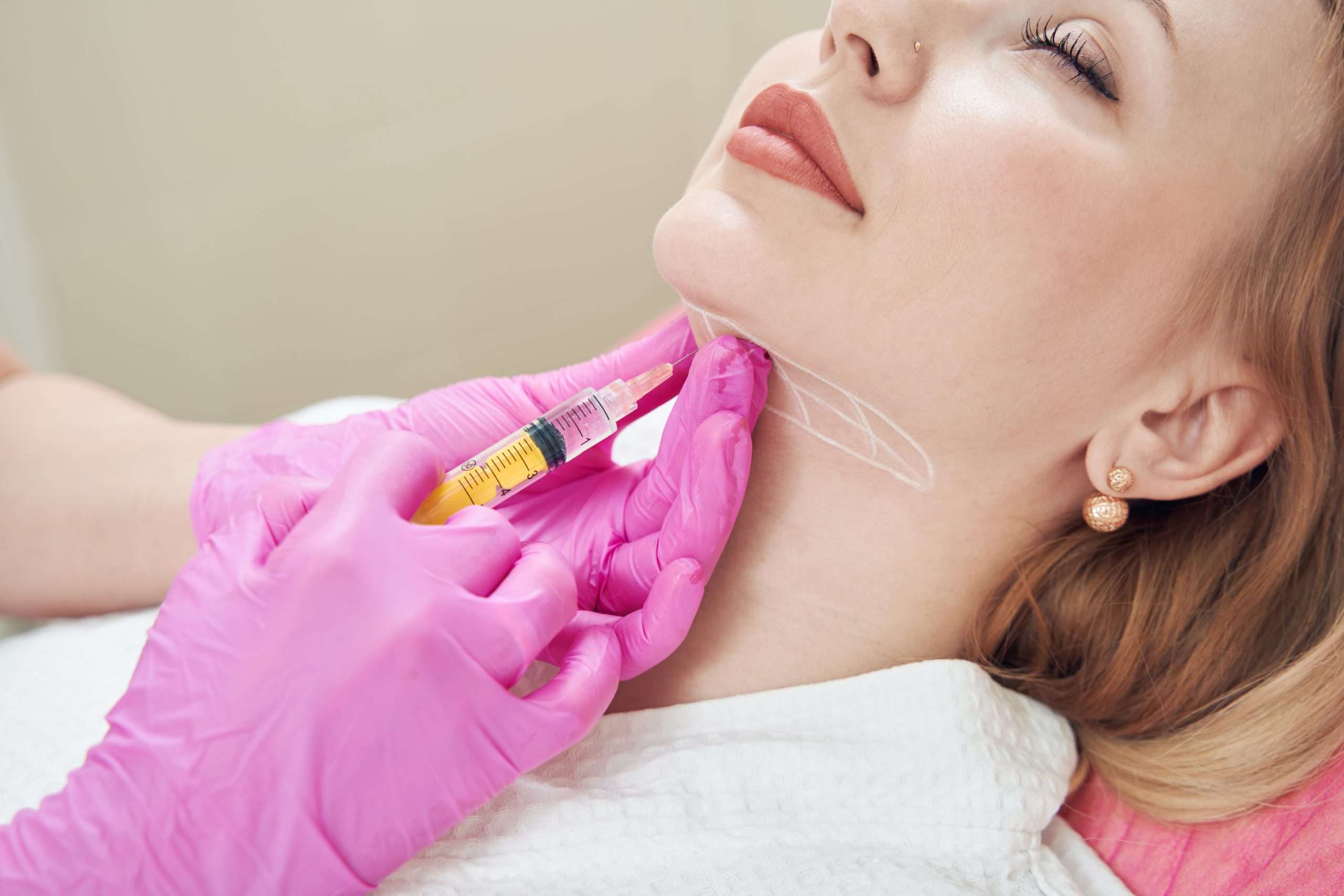 Neck Lift Non-Surgical image 1