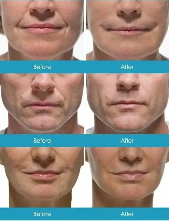 Jawline Contouring image 1