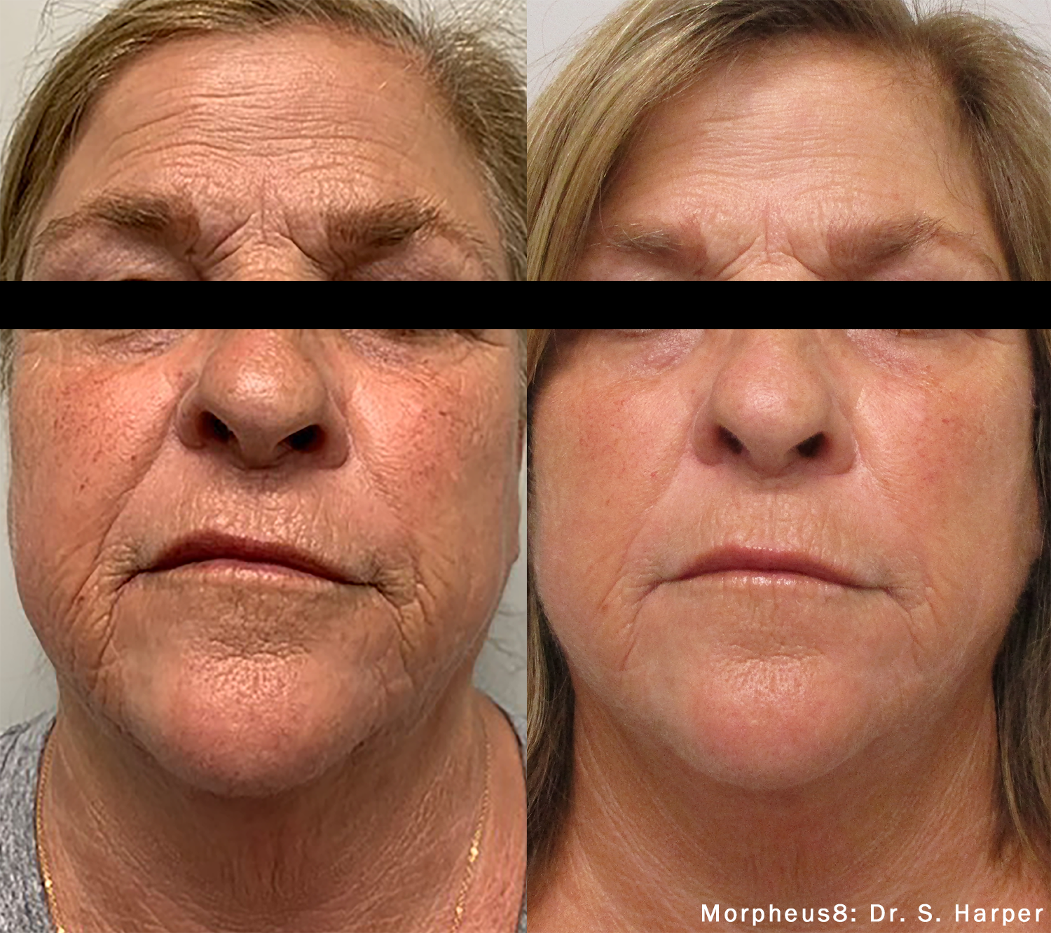 RF Microneedling image 1