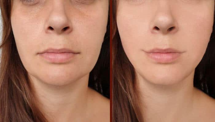 Restylane Defyne image 1