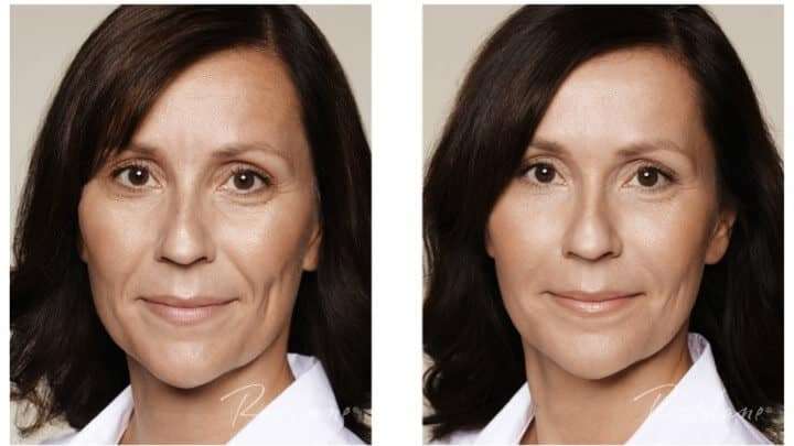 Restylane Refyne Under Eye Filler image 1