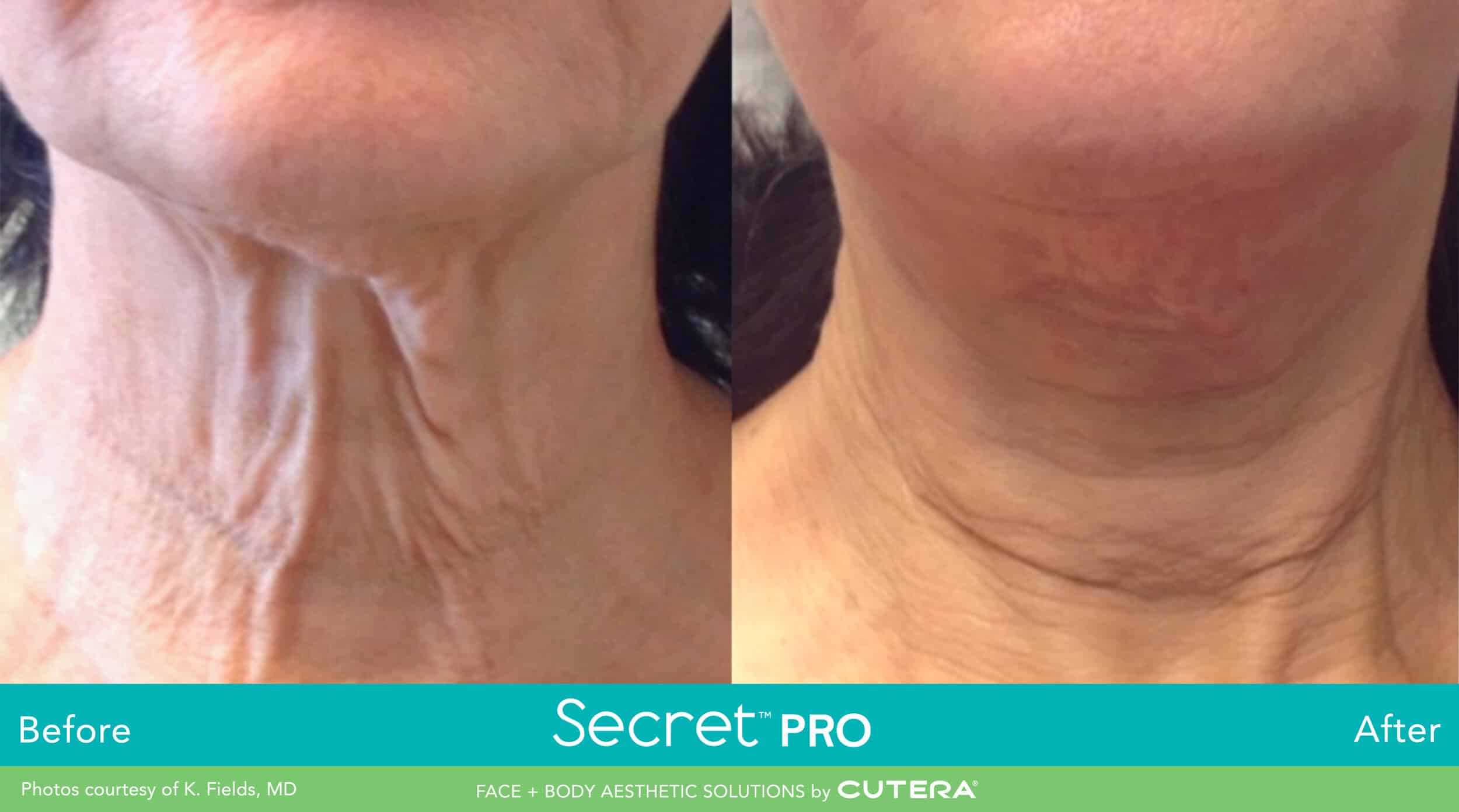 CO2 Laser Resurfacing image 1