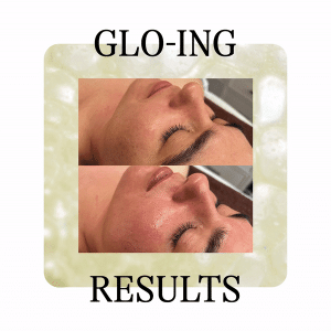 Ultimate Glo2 Facial Befor & After