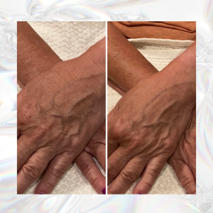 Ultimate Glo2 Facial Befor & After