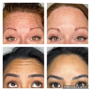 Botox Before & After